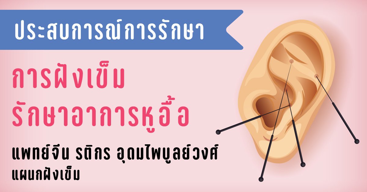 การฝังเข็มรักษาอาการหูอื้อ การฝังเข็มรักษาอาการหูอื้อ