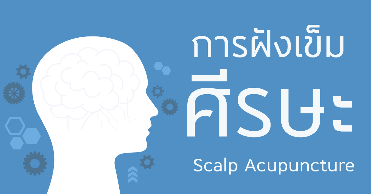 การฝังเข็มศีรษะ Scalp Acupuncture  การฝังเข็มศีรษะ Scalp Acupuncture