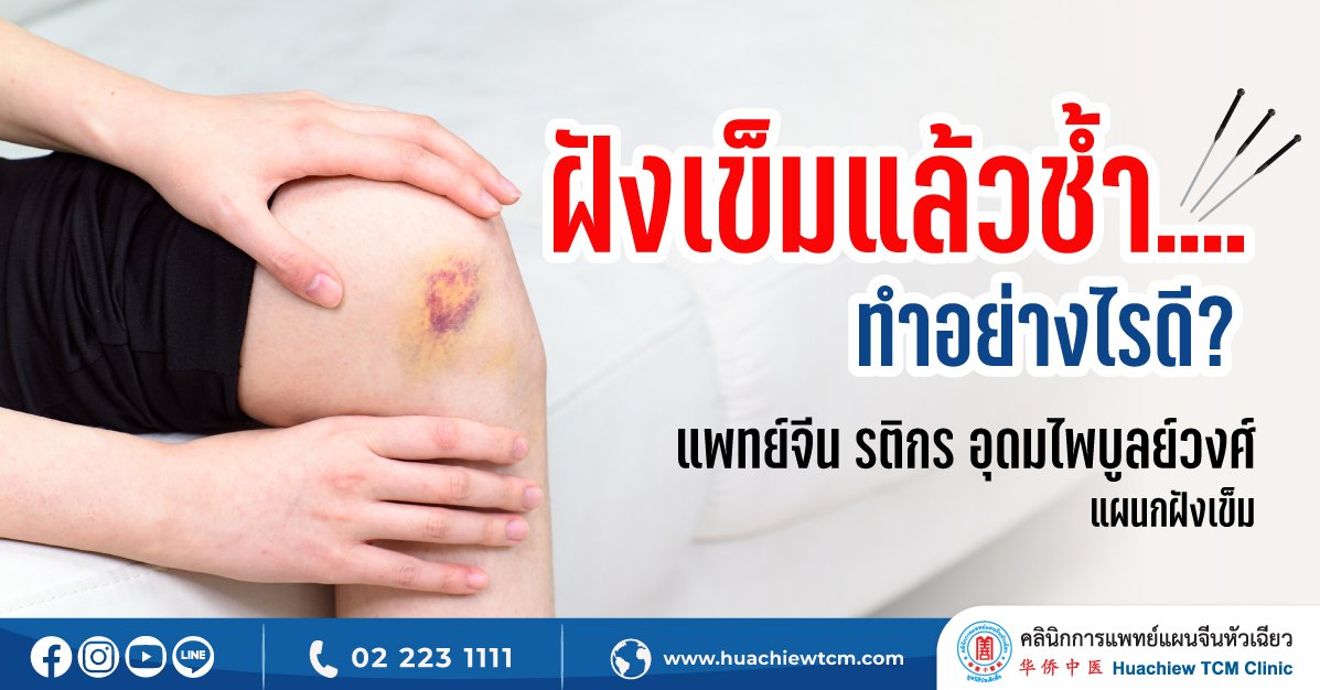 ฝังเข็มแล้วช้ำ....ทำอย่างไรดี? ฝังเข็มแล้วช้ำ....ทำอย่างไรดี?