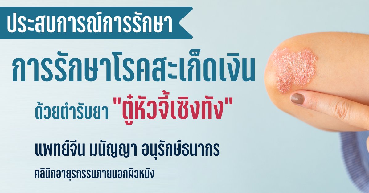 การรักษาโรคสะเก็ดเงินด้วยตำรับยา “ตู๋หัวจี้เซิงทัง” การรักษาโรคสะเก็ดเงินด้วยตำรับยา “ตู๋หัวจี้เซิงทัง”