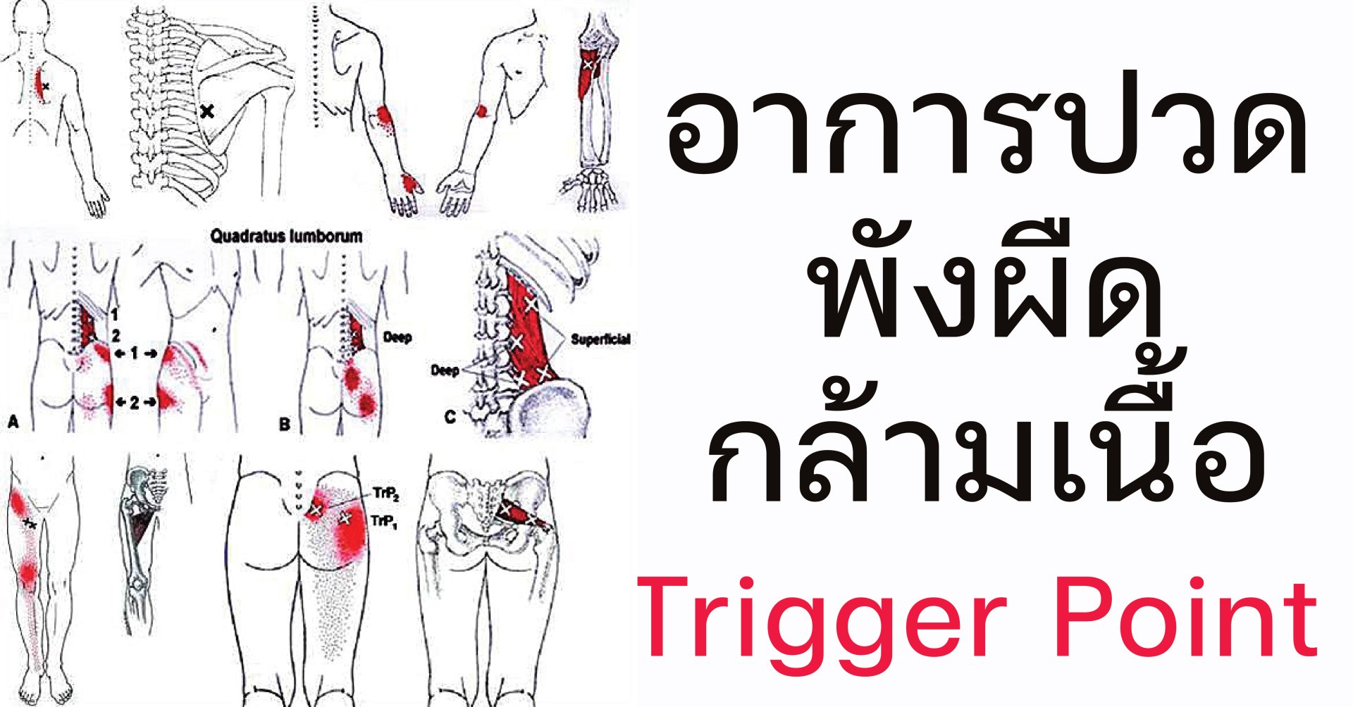 รักษาอาการปวดพังผืดกล้ามเนื้อ ด้วยวิธีทุยหนาแพทย์แผนจีน รักษาอาการปวดพังผืดกล้ามเนื้อ ด้วยวิธีทุยหนาแพทย์แผนจีน