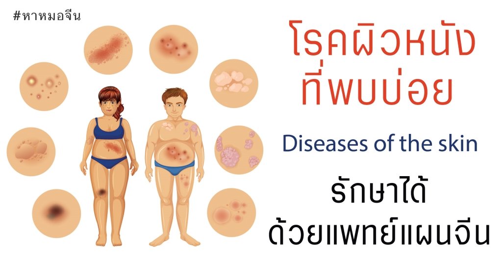 โรคผิวหนังที่พบบ่อย รักษาได้ด้วยวิธีแพทย์แผนจีน โรคผิวหนังที่พบบ่อย รักษาได้ด้วยวิธีแพทย์แผนจีน