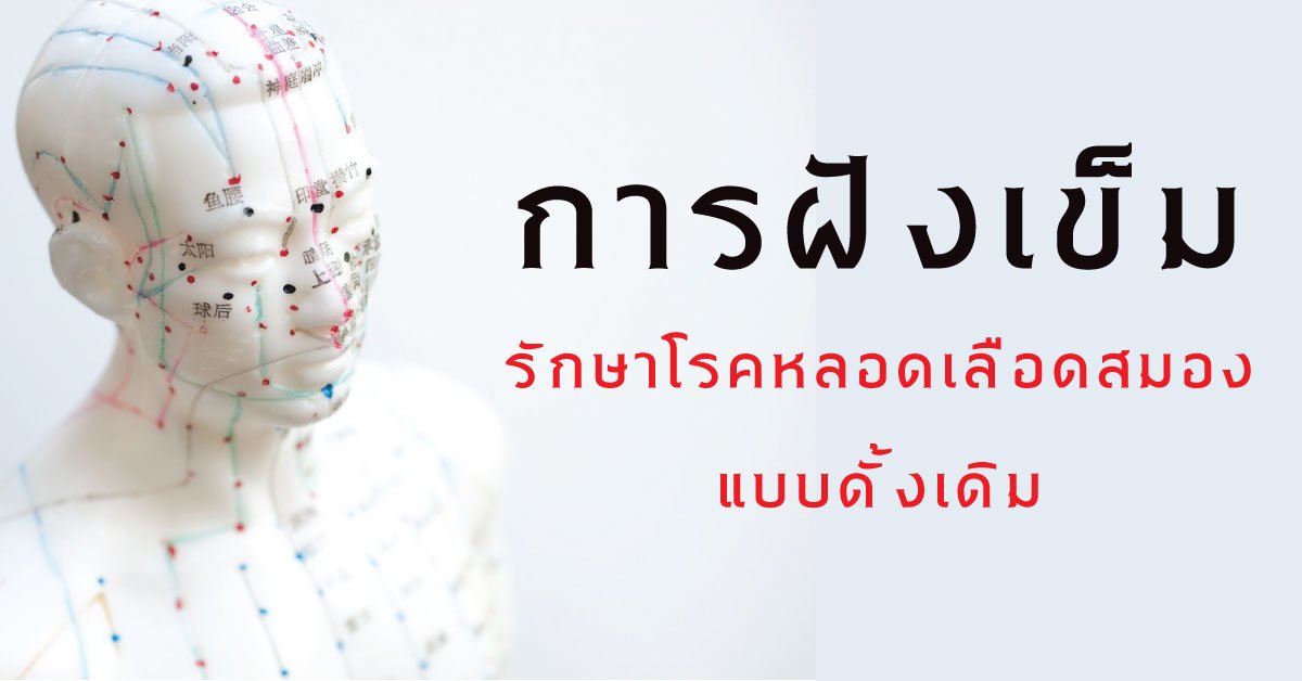 การฝังเข็มรักษาโรคหลอดเลือดสมองแบบดั้งเดิม การฝังเข็มรักษาโรคหลอดเลือดสมองแบบดั้งเดิม