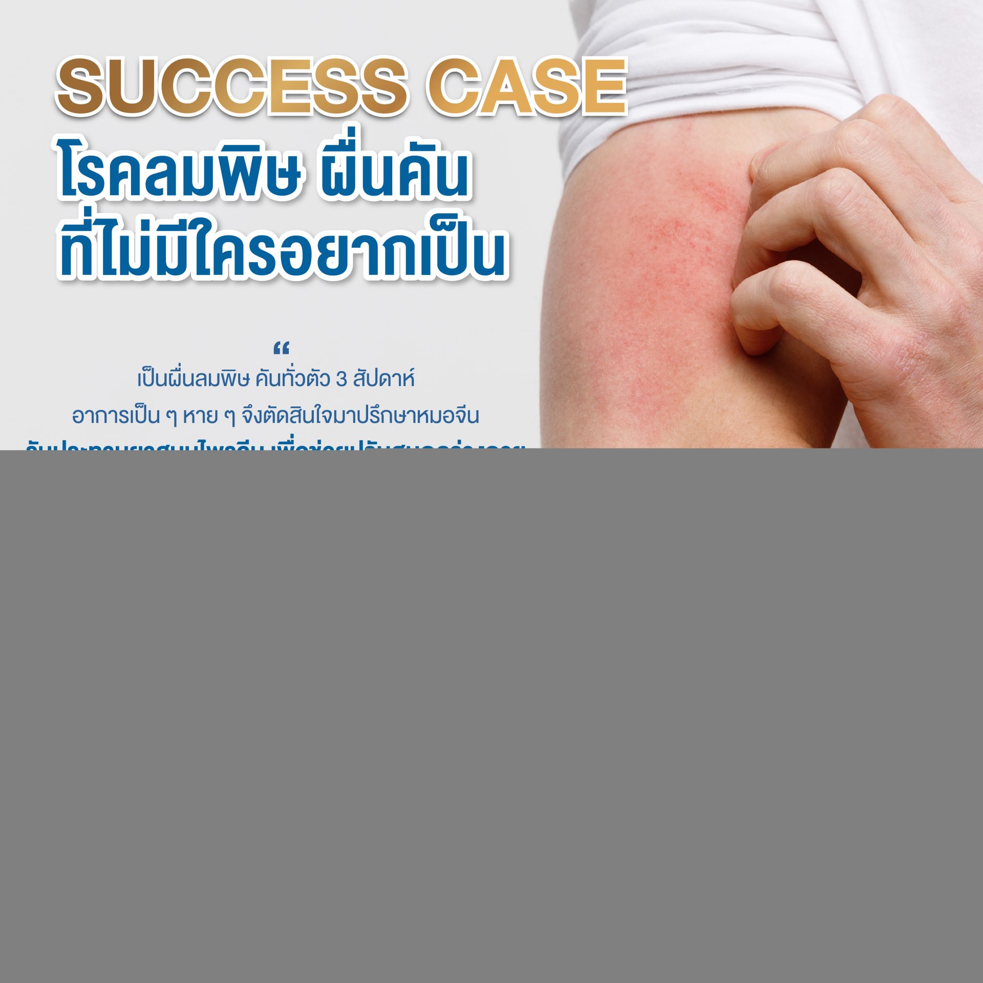Success case โรคลมพิษ ผื่นคันที่ไม่มีใครอยากเป็น