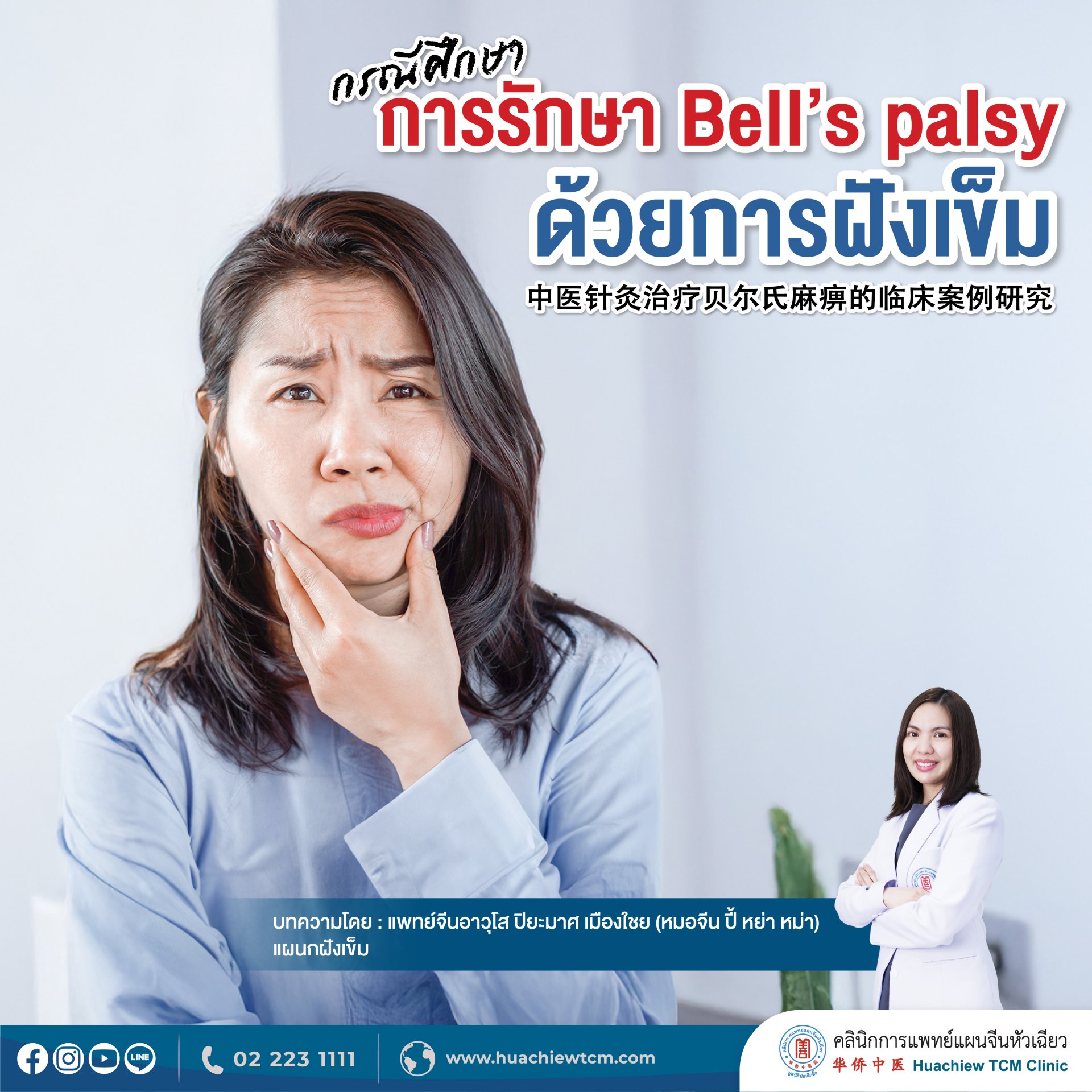 การรักษาเคสอัมพาตใบหน้า Bells Palsy ดัวยการฝังเข็ม การรักษาเคสอัมพาตใบหน้า Bells Palsy ดัวยการฝังเข็ม