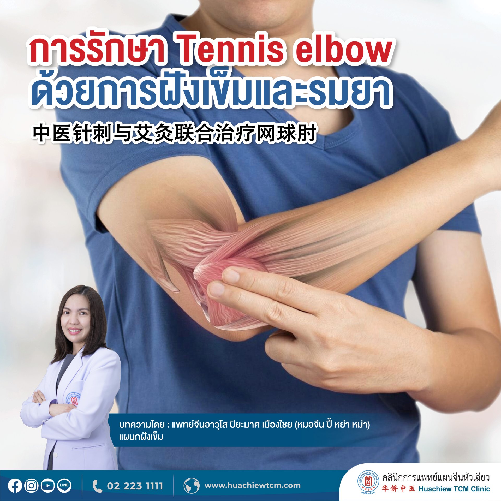 การรักษา Tennis elbow ด้วยการฝังเข็มและรมยา