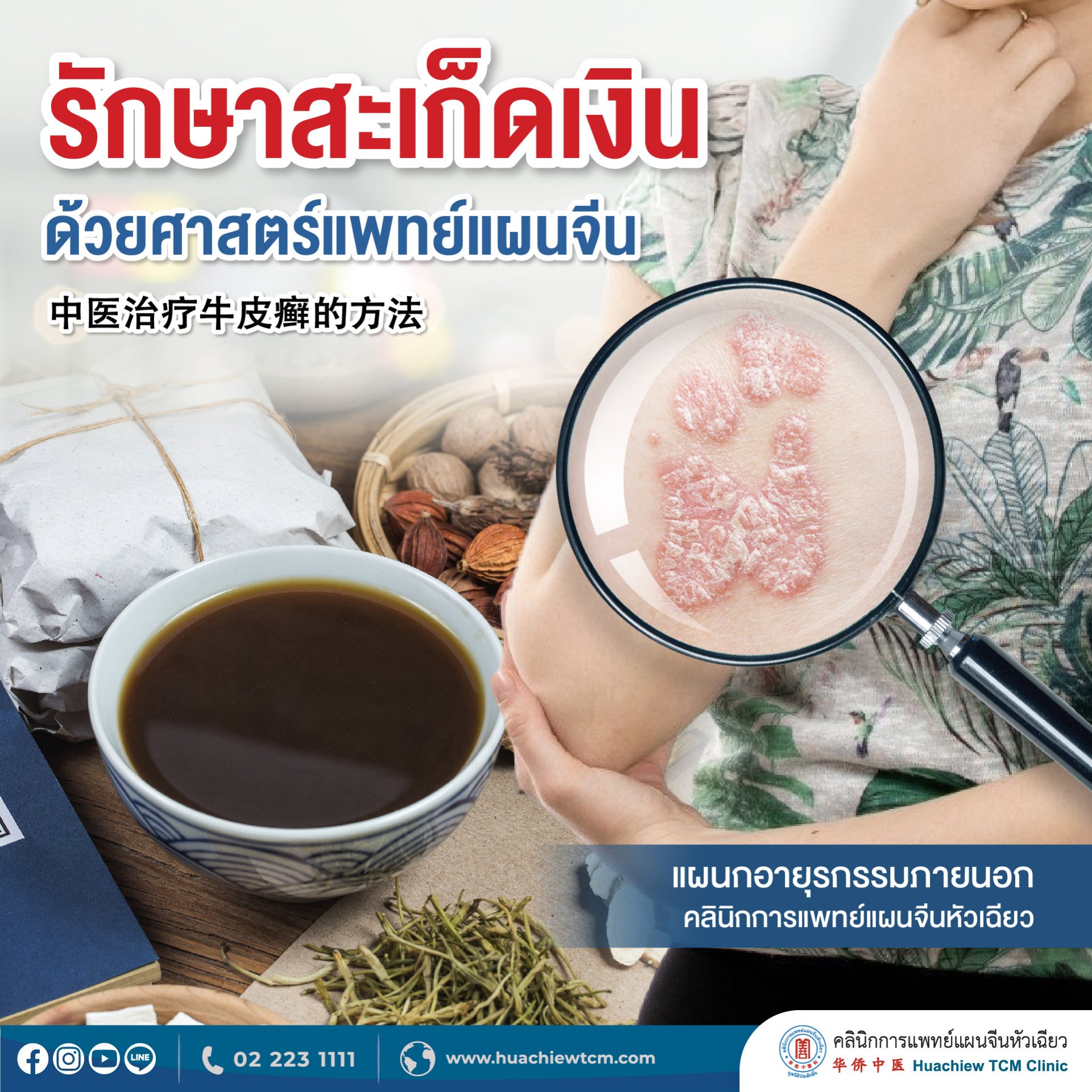 รักษาสะเก็ดเงิน ด้วยศาสตร์การแพทย์แผนจีน รักษาสะเก็ดเงิน ด้วยศาสตร์การแพทย์แผนจีน