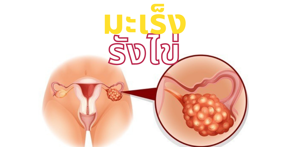 มะเร็งรังไข่ในผู้หญิง มะเร็งรังไข่ในผู้หญิง