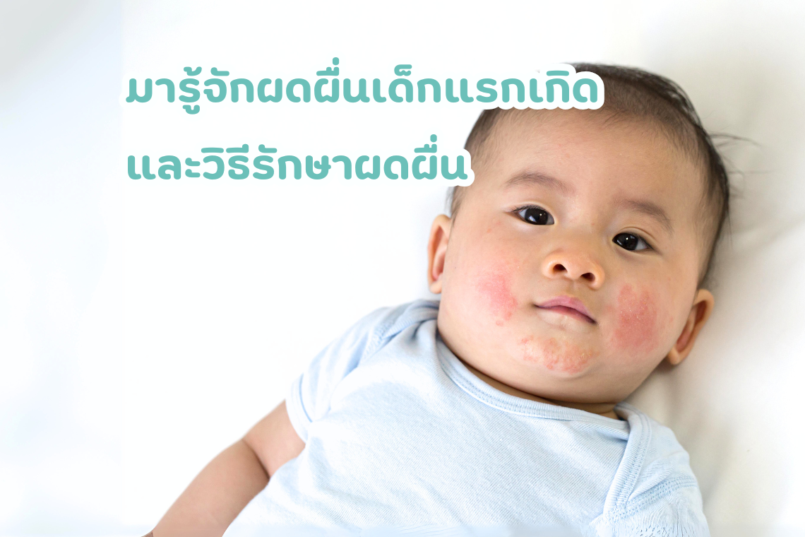 ผดผื่นคันในเด็ก ผื่นผ้าอ้อม