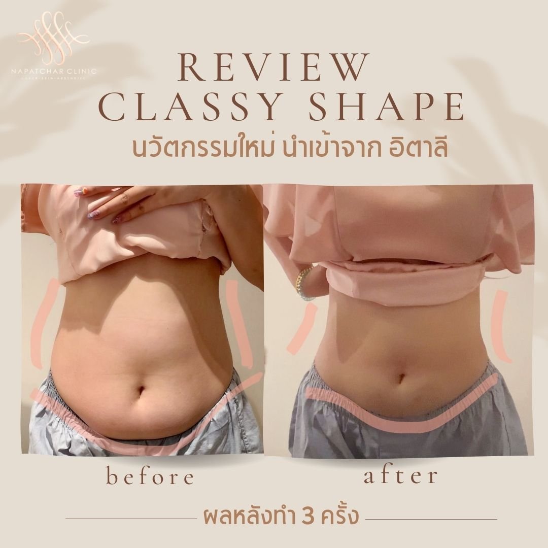 ลดไขมัน สลายเซลลูไลต์ กระชับผิว ด้วย Classy Shape จากอิตาลี ไม่เจ็บ ไม่ใช้เข็ม ลดไขมัน สลายเซลลูไลต์ กระชับผิว ด้วย Classy Shape จากอิตาลี ไม่เจ็บ ไม่ใช้เข็ม