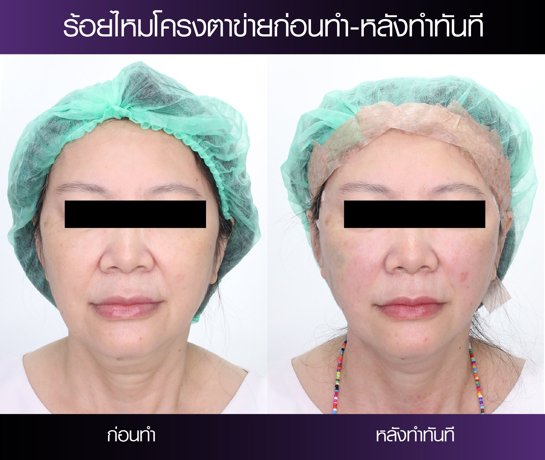 ไหมโครงตาข่าย Tesslift ยกกระชับหน้า ที่สุด ณ ตอนนี้ ไหมโครงตาข่าย Tesslift ยกกระชับหน้า ที่สุด ณ ตอนนี้