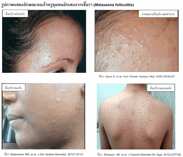 สิวยีสต์ สิวเชื้อรา สิวผด รักษายังไงดี สิวยีสต์ สิวเชื้อรา สิวผด รักษายังไงดี