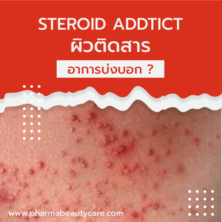 สิวสเตอรอยด์ แพ้สเตอรอยด์ บทความโดยเภสัชกร ผิวติดสาร