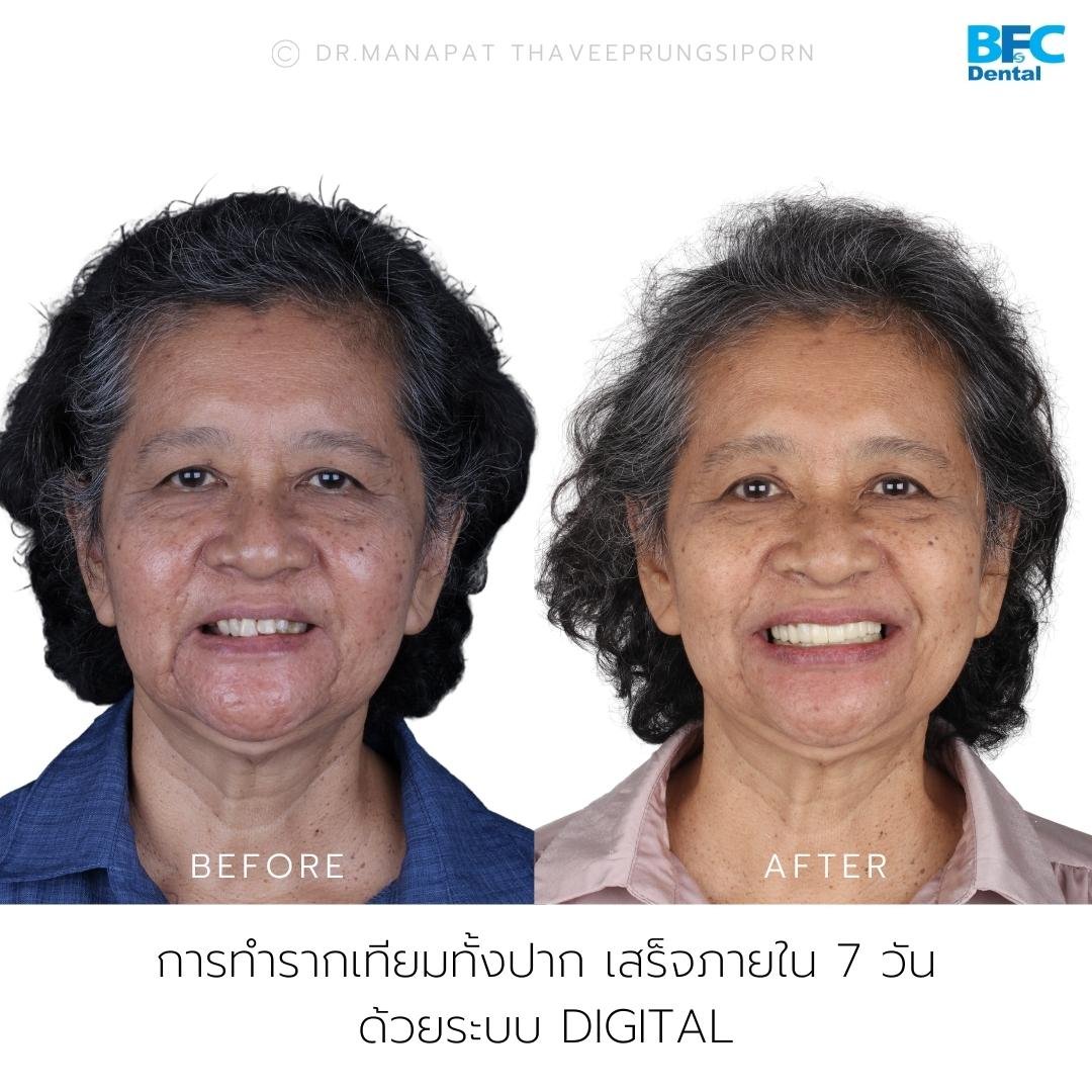 Smile Trasformation in 7 days with All-on-4 Implant