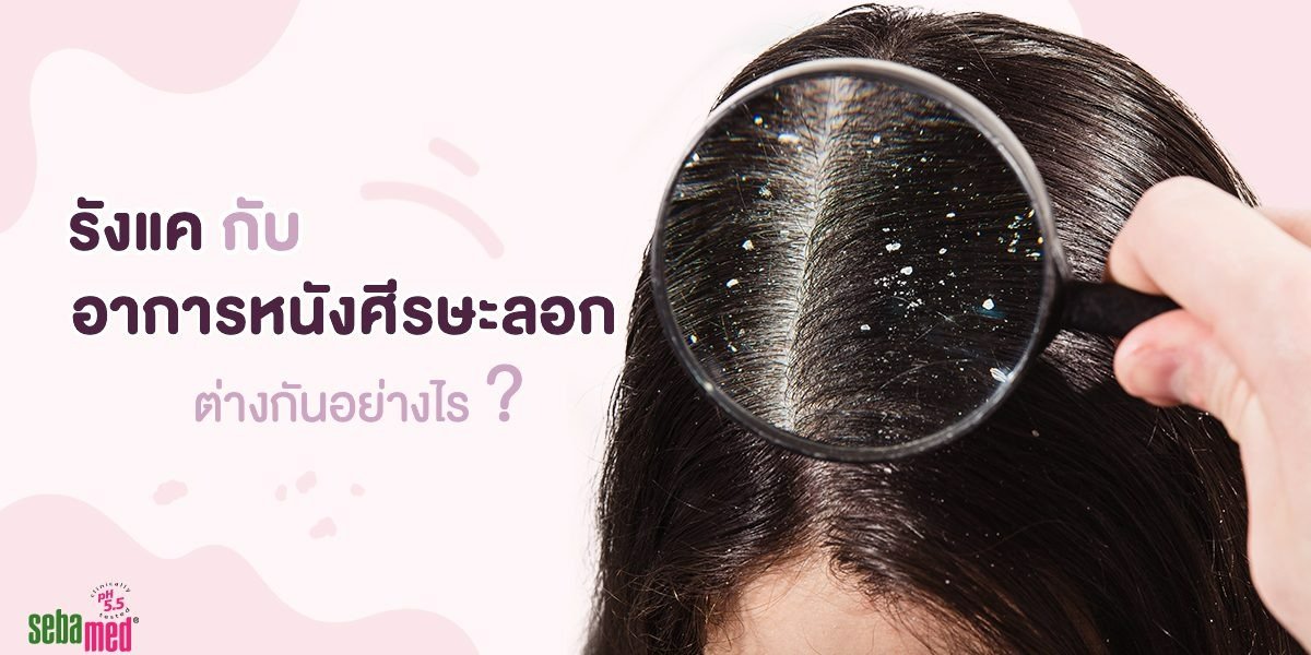 รังแคกับอาการหนังศรีษะลอกต่างกันอย่างไร?  รังแคกับอาการหนังศรีษะลอกต่างกันอย่างไร?