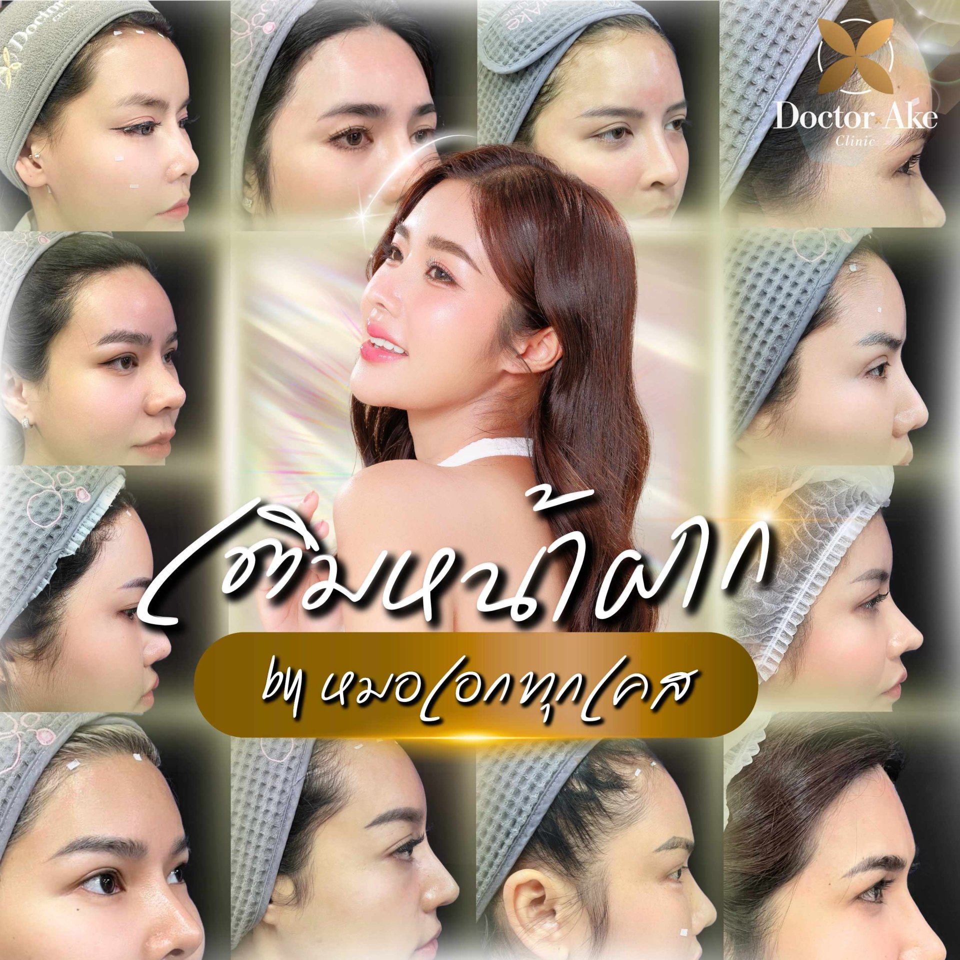 โปรแกรม Filler หน้าผาก