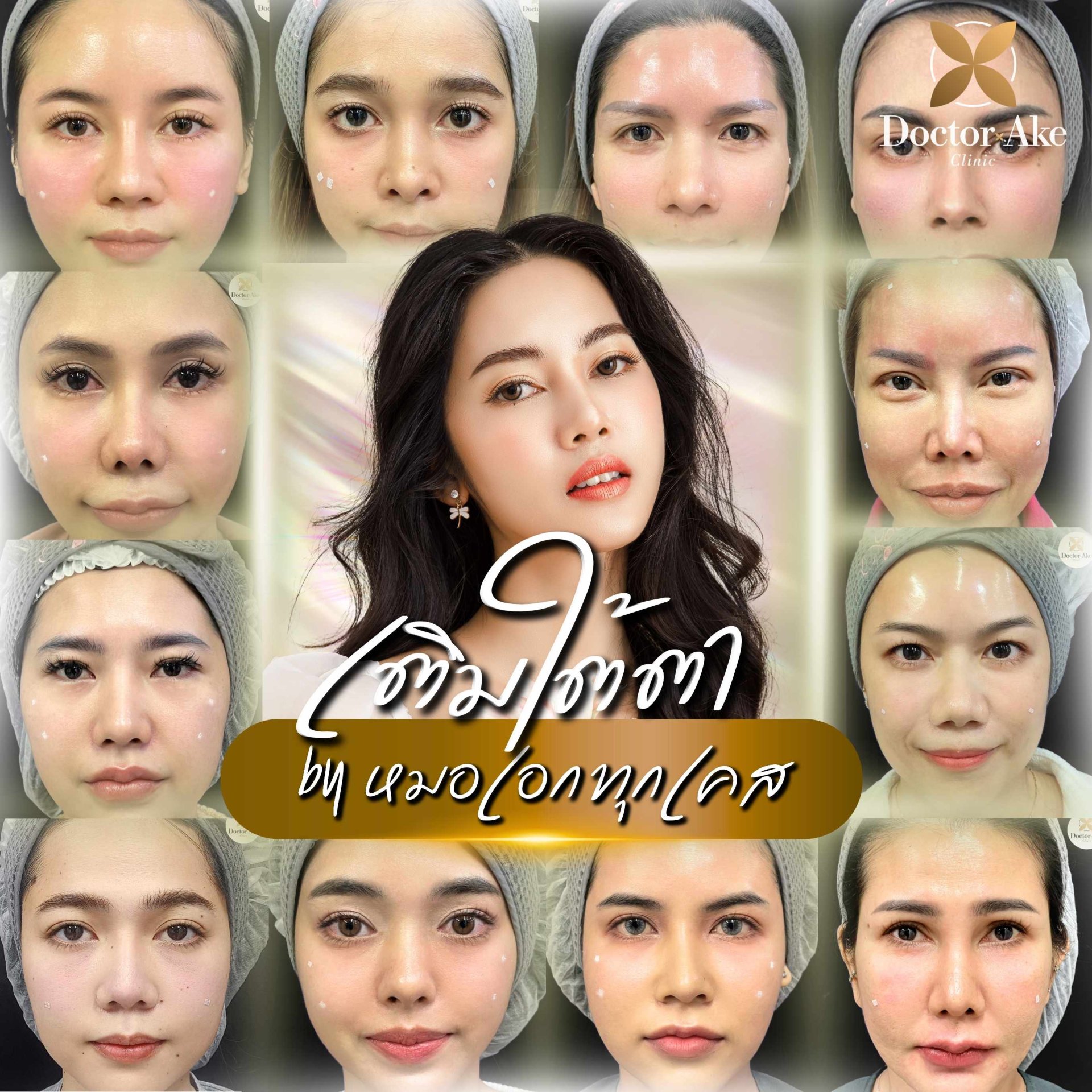Filler ใต้ตา