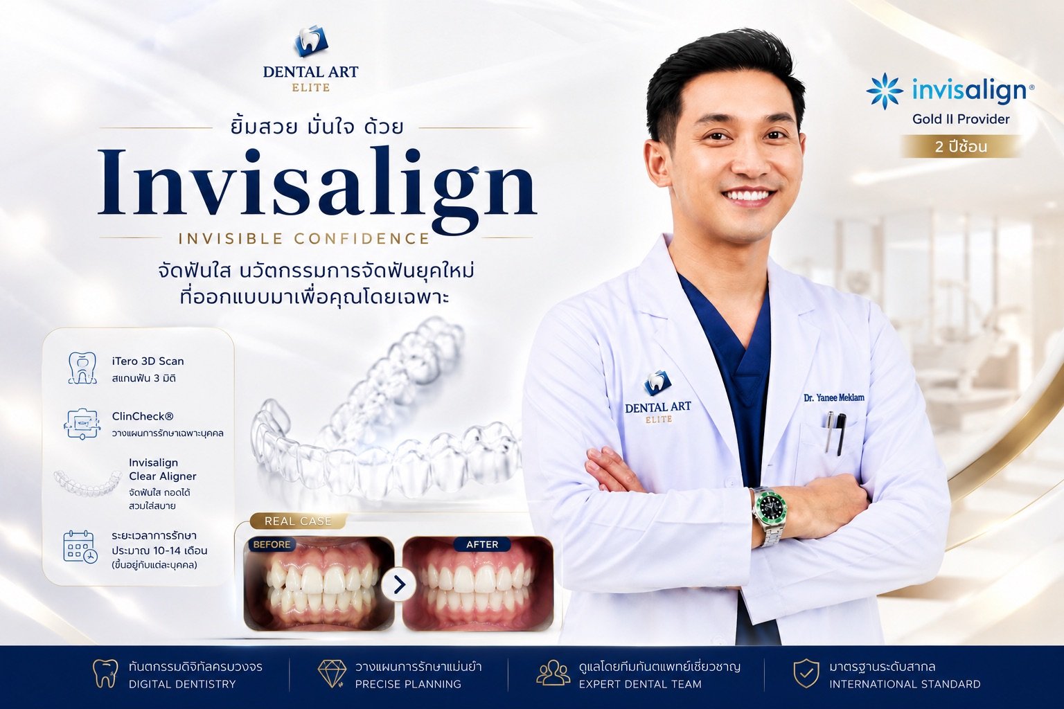 เคสจัดฟันใส Invisalign ก่อนและหลัง | Dental Art Elite