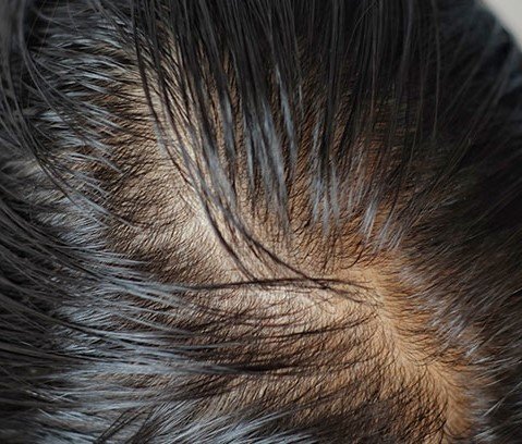 หัวมัน ผมมันง่ายเกิดจากอะไร? เข้าใจสาเหตุและวิธีดูแลหนังศีรษะให้สมดุล