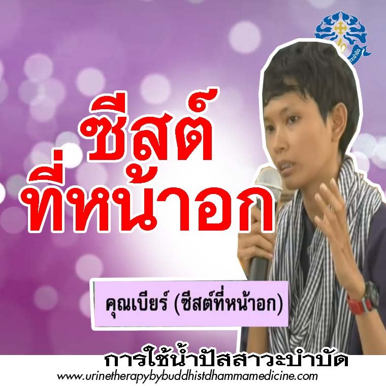 ซีสต์ ซีสต์