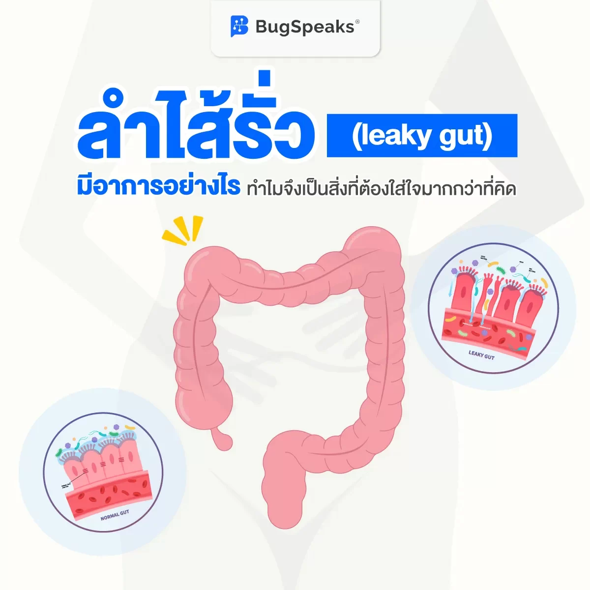 ลำไส้รั่ว (leaky gut) มีอาการอย่างไร ทำไมจึงเป็นสิ่งที่ต้องใส่ใจมากกว่าที่คิด