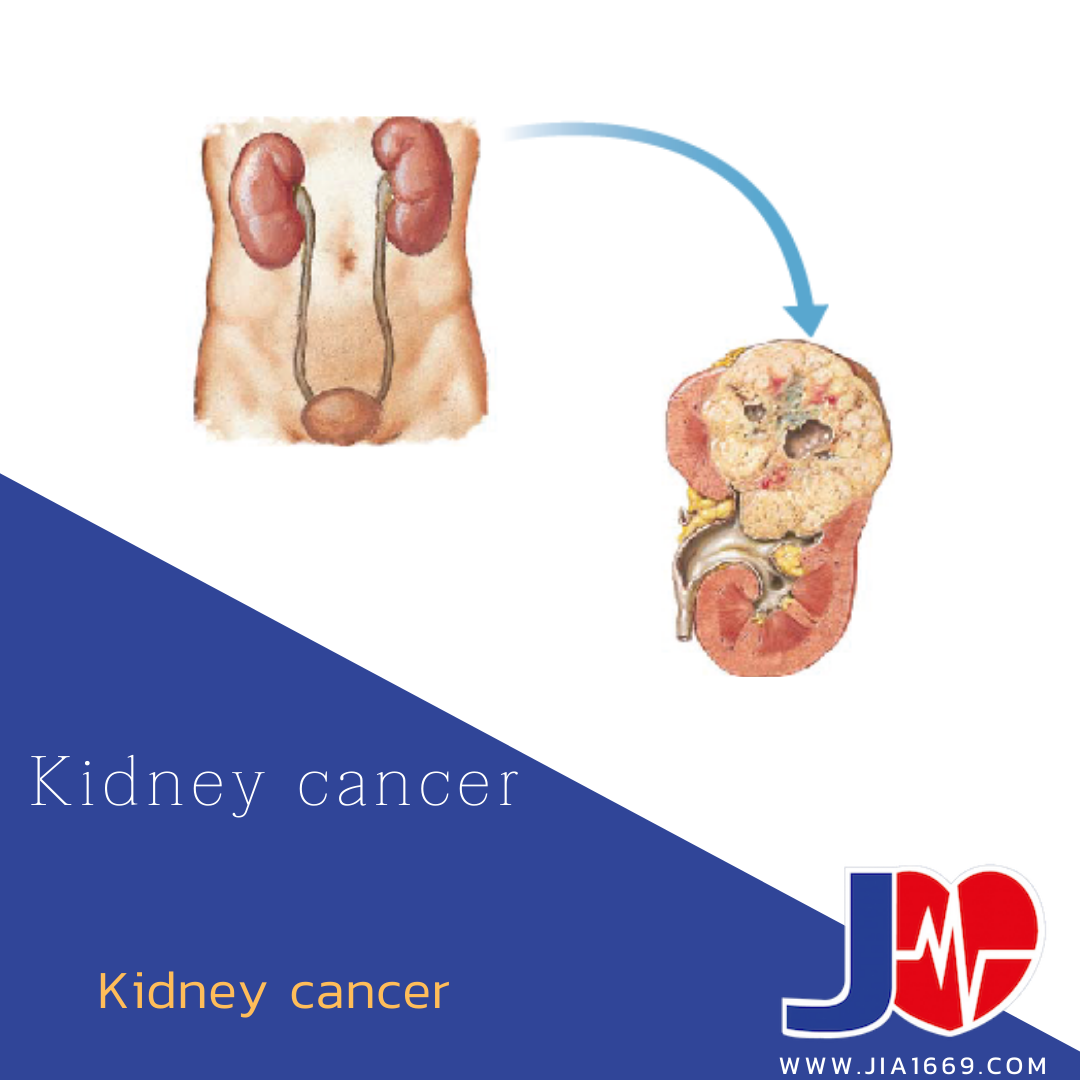Kidney Cancer  Kidney Cancer