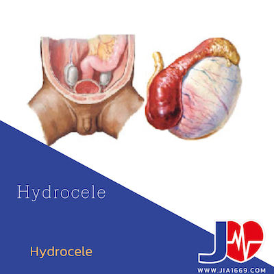 HYDROCELE ถุงน้ำลูกอัณฑะ HYDROCELE ถุงน้ำลูกอัณฑะ