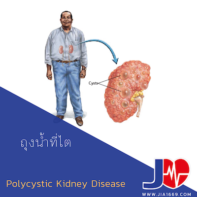polycystic kidney disease โรคถุงน้ำที่ไต polycystic kidney disease โรคถุงน้ำที่ไต