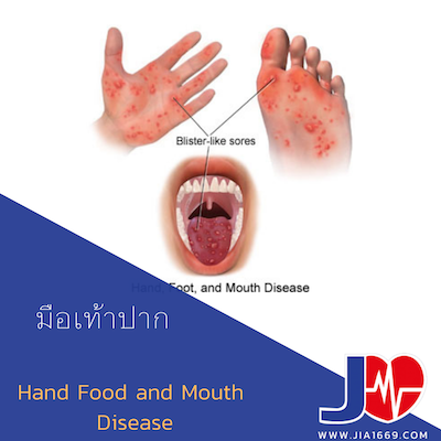 Hand, Foot, and Mouth Disease โรคมือเท้าปาก
