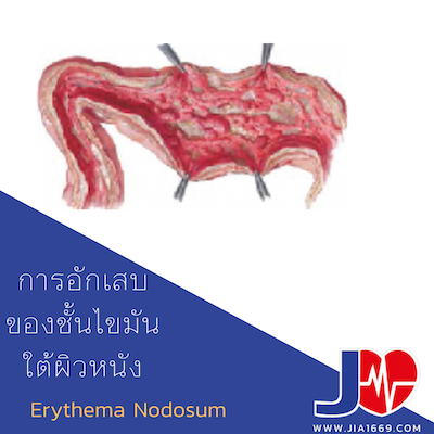 การอักเสบของชั้นไขมันใต้ผิวหนัง Erythema Nodosum การอักเสบของชั้นไขมันใต้ผิวหนัง Erythema Nodosum