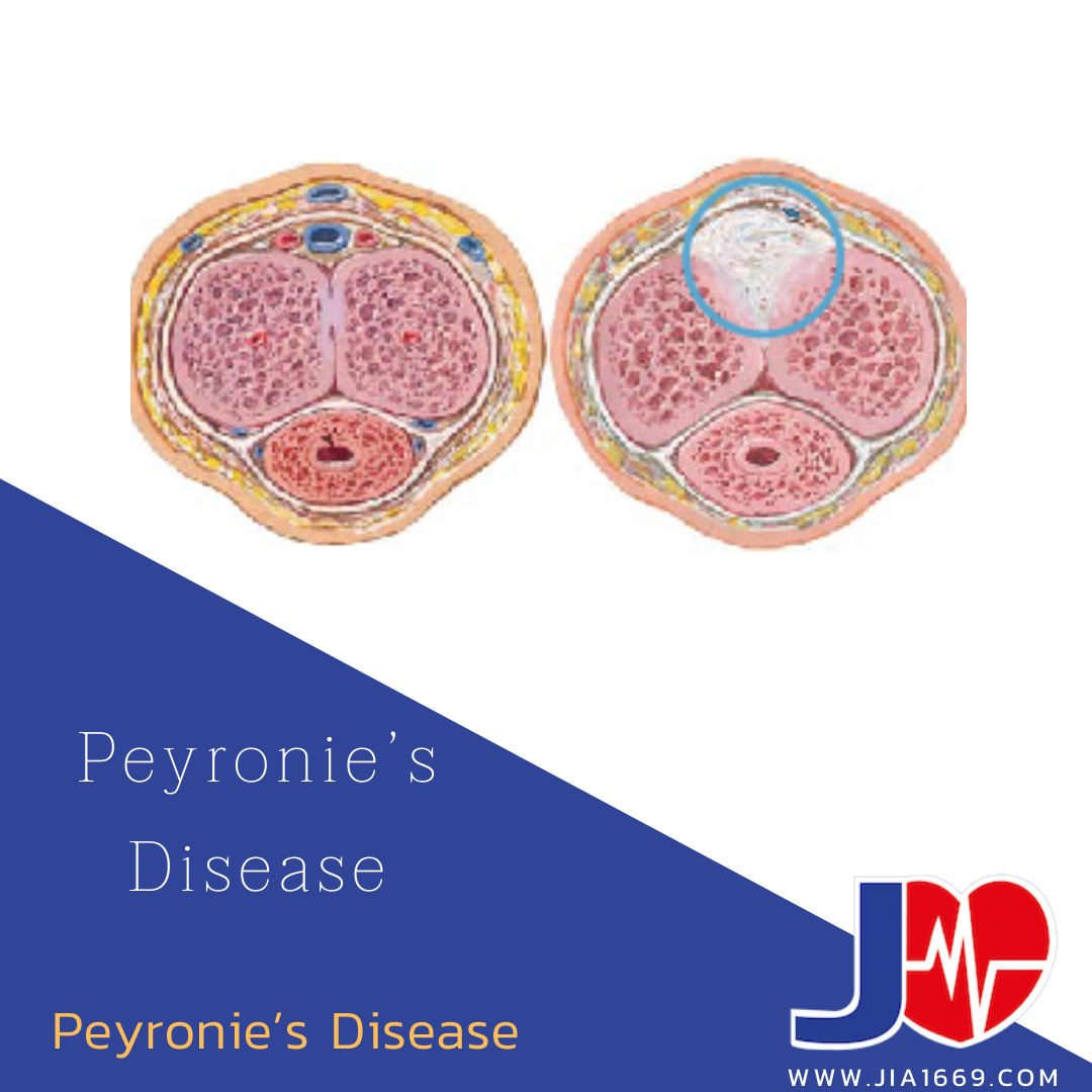 Peyronie’s Disease โรคไพโรนีย์ Peyronie’s Disease โรคไพโรนีย์