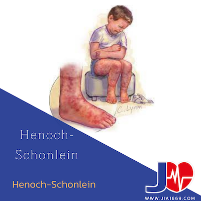 Henoch -schonlein  Henoch -schonlein