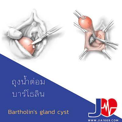 Bartholin's gland cyst
