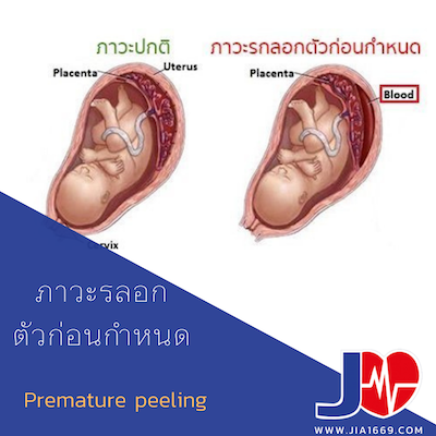 Premature abruption Premature abruption