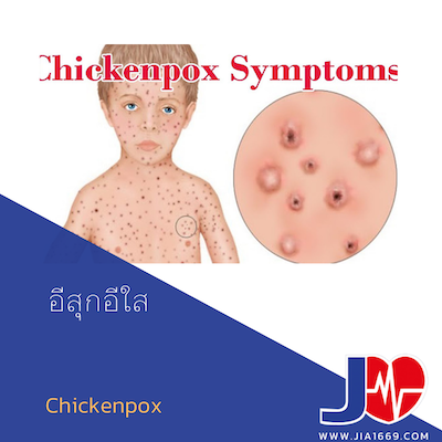 Chickenpox Chickenpox