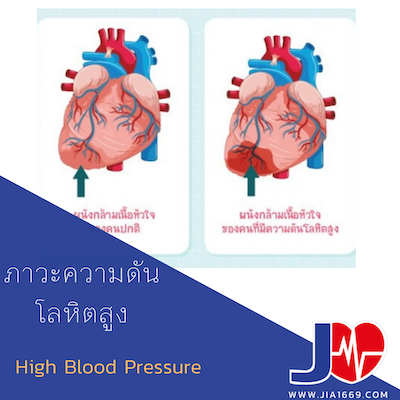 high blood pressure