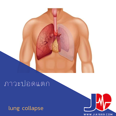 lung collapse
