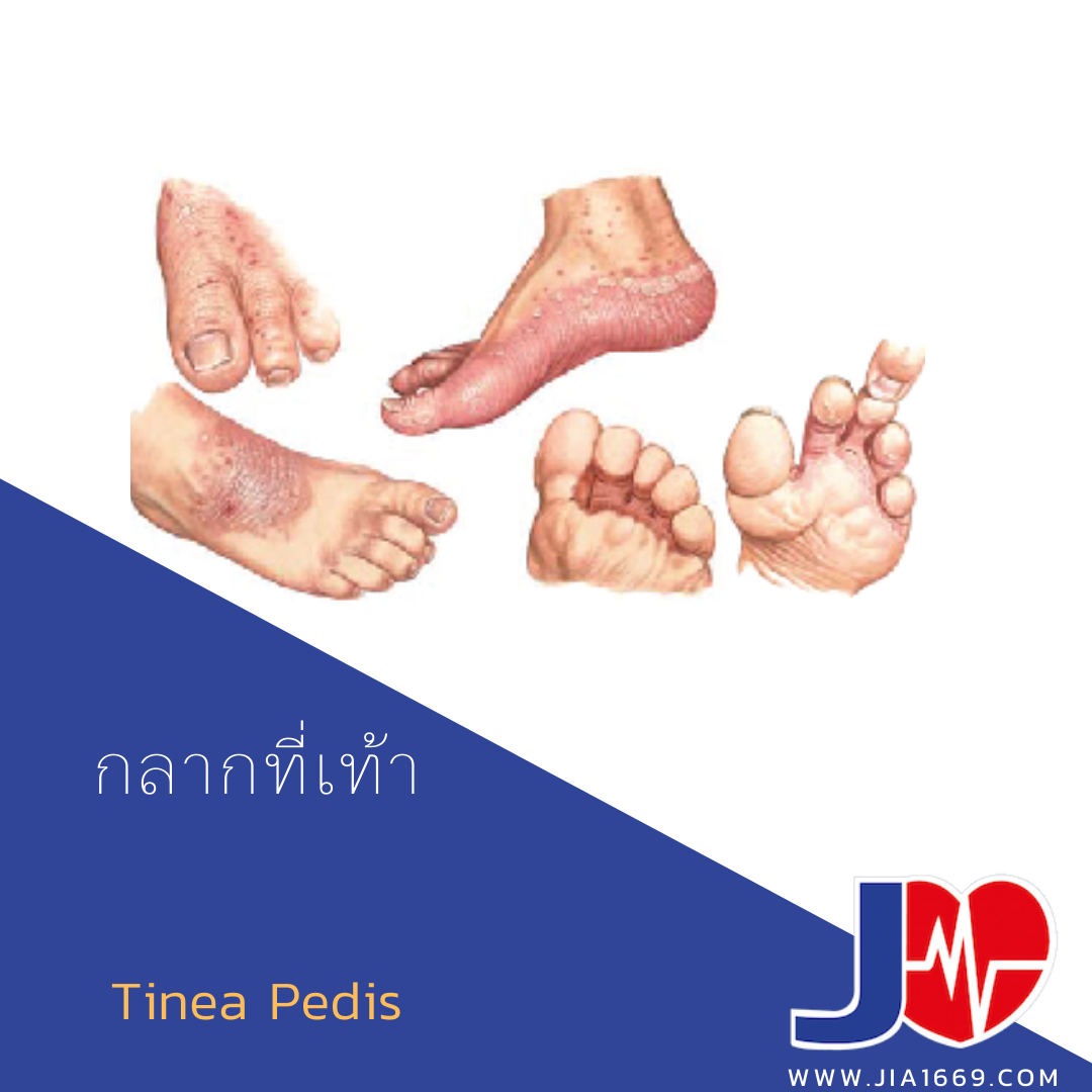โรคกลากที่เท้า Tinea Pedis โรคกลากที่เท้า Tinea Pedis
