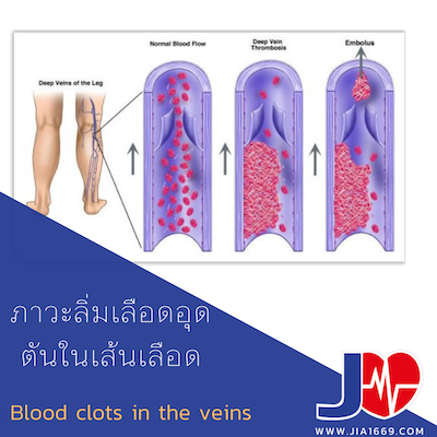 ภาวะลิ่มเลือดอุดตันในเส้นเลือด ภาวะลิ่มเลือดอุดตันในเส้นเลือด