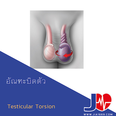 Testicular Torsion Testicular Torsion