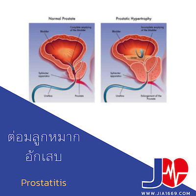 Prostatitis โรคต่อมลูกหมากอักเสบ Prostatitis โรคต่อมลูกหมากอักเสบ