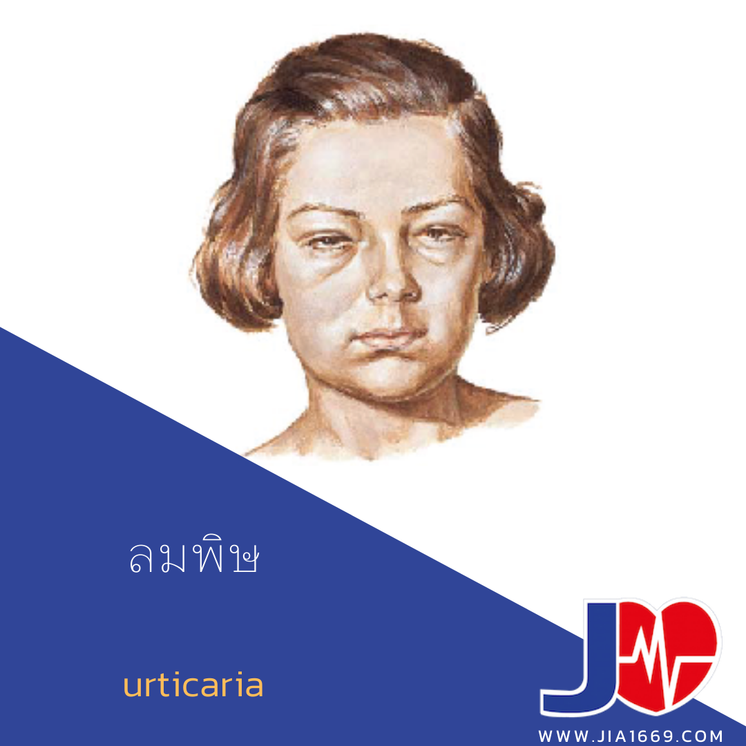 โรคลมพิษ โรคลมพิษ