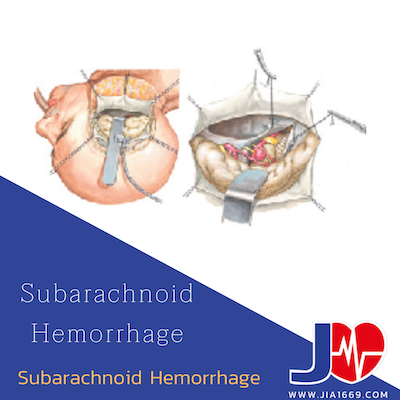 Subarachnoid Hemorrhage Subarachnoid Hemorrhage