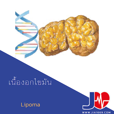 Lipoma เนื้องอกไขมัน Lipoma เนื้องอกไขมัน