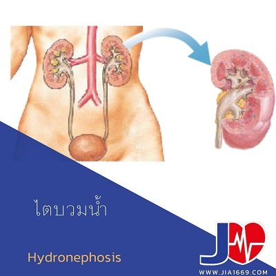 hydronephrosis hydronephrosis