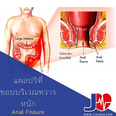 แผลปริที่ขอบทวารหนัก Anal Fissure แผลปริที่ขอบทวารหนัก Anal Fissure