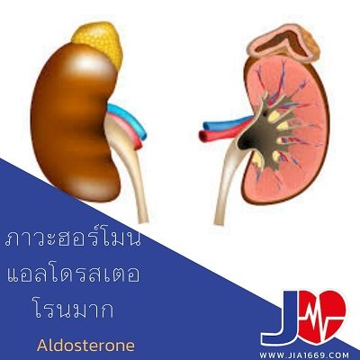 ALDOSTERONISM ALDOSTERONISM