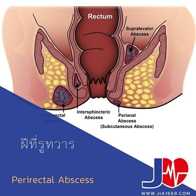ฝีที่รูทวาร PERIRECTAL ABSCESS ฝีที่รูทวาร PERIRECTAL ABSCESS