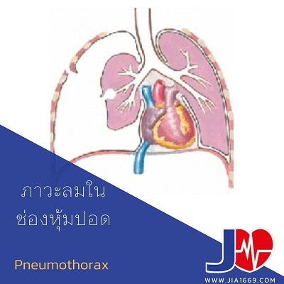 ภาวะลมในช่องหุ้มปอด Pneumothorax ภาวะลมในช่องหุ้มปอด Pneumothorax