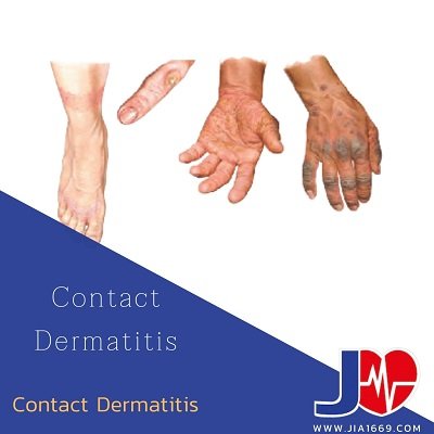 CONTACT DERMATITIS ผื่นแพ้สัมผัส CONTACT DERMATITIS ผื่นแพ้สัมผัส